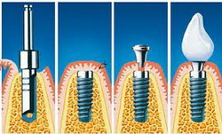 Процесс имплантации зуба