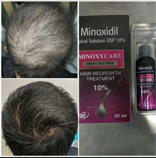 Препарат Minoxidil 10% - 60мл. : общая информация и описание, свойства ...