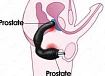 Урологический массажер:uz:Prostata urologik massaji