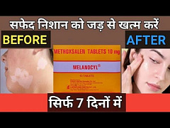 Vitiligo uchun melanocyl (Melanocyl) tabletkalari