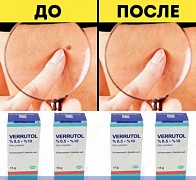 Papillomadan Verrutol