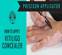 Vitiligo yashiruvchi Zanderm Vitiligo yashiruvchi