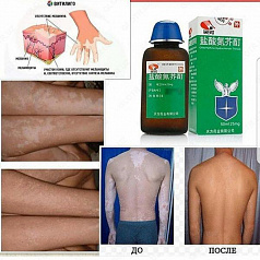 Препараты для лечения витилиго ласён:uz:Vitiligo lasyonni davolash uchun dorilar (original)