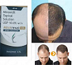 Mitotrexal для роста волос (Minoxidil 10%)