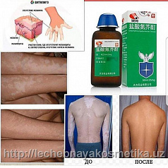 Препараты для лечения витилиго:uz:Vitiligo davolash uchun dorilar