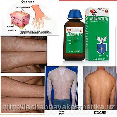 Препараты для лечения витилиго:uz:Vitiligo davolash uchun dorilar