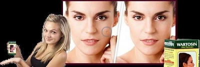 Wartosin - Вартосин (удаление бородавок) Wartosin - Вартосин (удаление бородавок)