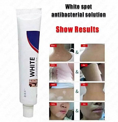 Антибактериальный крем от белых пятен витилиго:uz:Vitiligo oq dog'lar uchun antibakterial krem