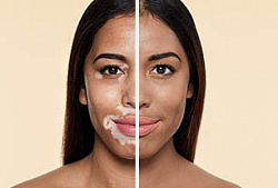 Vitiligo va pigmentatsiya uchun krem ​​