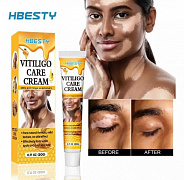 Крем от витилиго Vitiligo Care Crem HBESTY